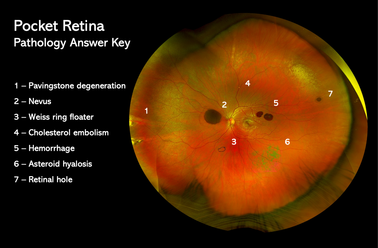 Pocket Retina